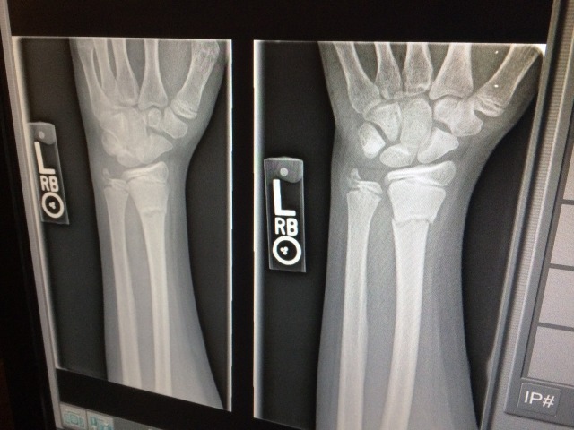 X-ray broken arm